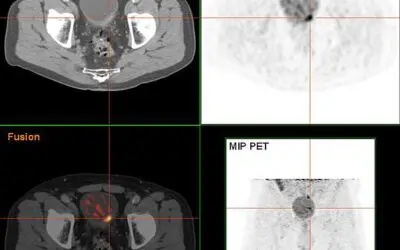 Neuer Urintest verbessert die Genauigkeit der Früherkennung von Blasenkrebs