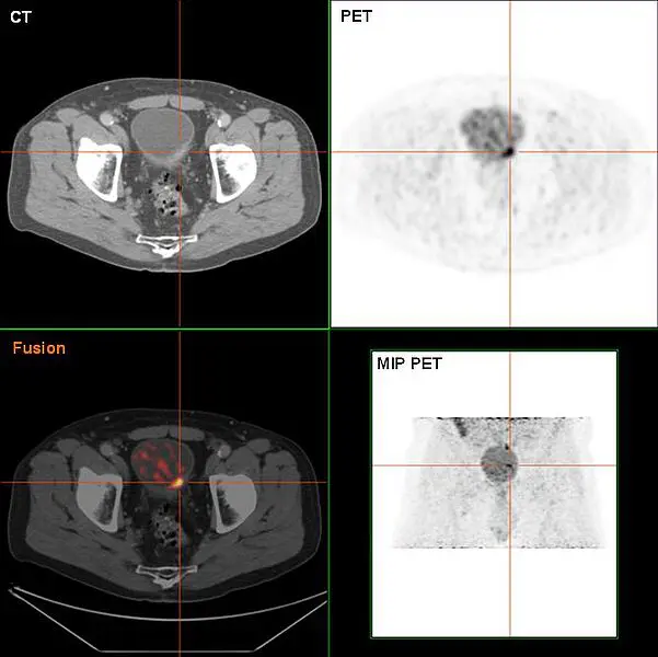 Blasenkrebs in der FDG-PET/CT-Darstellung. Credits: Wikipedia/Gemeinfrei