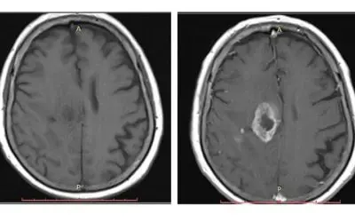 MRT: Radiologische Diagnostik kann Gadoliniumdosis halbieren
