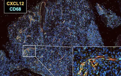 Spiegelmere sollen Glioblastome bekämpfen