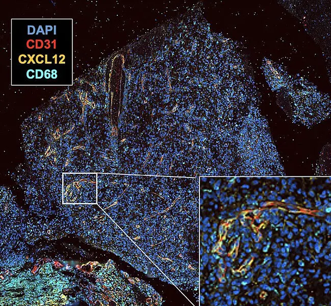 Dargestellt ist ein Gewebsstück eines Glioblastoms. Die Gefäße sind rot, der Botenstoff CXCL12 gelb gefärbt. Die Darstellung zeigt, dass der Botenstoff um Gefäße herum gebildet wird. | Copyright: Universitätsklinikum Bonn 