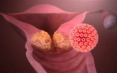 Gebärmutterhalskrebs-Prävention: Mediziner empfehlen HPV-Impfung zum Schulwechsel