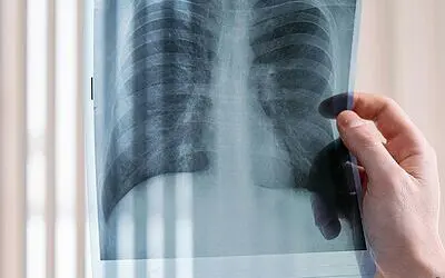 IQWiG: Lungenkrebsscreening mittels Low-Dose-CT kann Leben retten