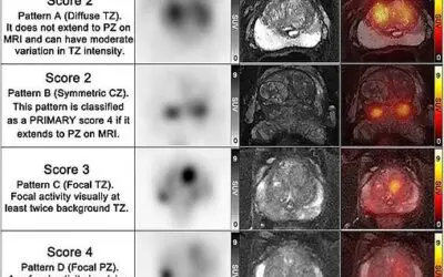 Bildgebende Verfahren: PET/MRT kann unnötige Biopsien bei Prostatakrebs vermeiden helfen