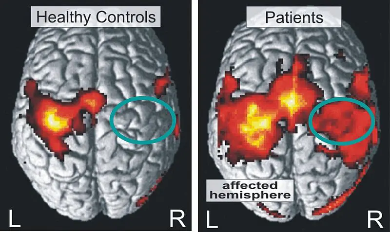 Credits: Dr. C Grefkes, Uniklinik Köln - Eigenes Werk Cortical Activation in Healthy Subjects and Stroke Patients/ Wikipedia / CC BY 3.0