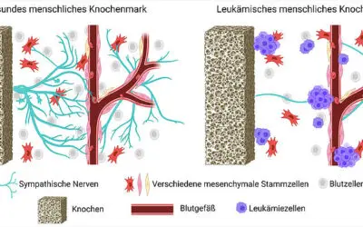 AML und und Chemotherapie schädigen langfristig das Nervensystem im Knochenmark