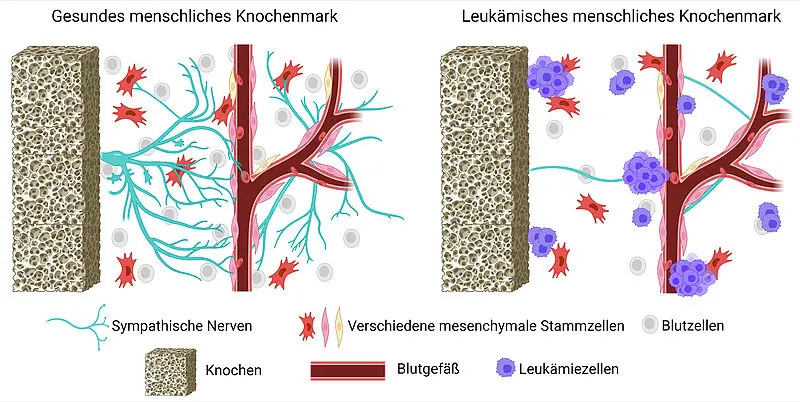 Vereinfachtes Schema des gesunden und leukämischen menschlichen Knochenmarks. Leukämie führt zur Schädigung und zum Verlust von Nerven, was das Gleichgewicht der Blutzellenentwicklung stören kann. Abbildung erstellt mit BioRender. | Copyright: © Tatyana Grinenko and Iryna Kovtun |