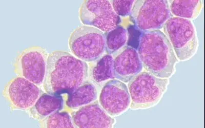 Chemotherapie bei AML ohne Doppelinduktion wirksam