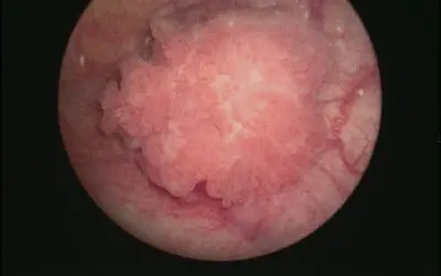 Blasenkrebs: Berechnung der Urin-Werte erlaubt Aussage zur “Chemo-Tauglichkeit” des Patienten