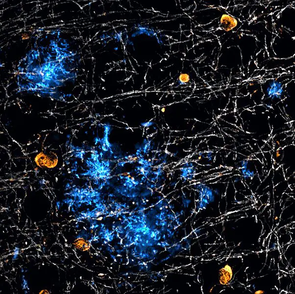 Bei Alzheimer bilden nicht nur Nervenzellen das Protein Beta-Amyloid (blau), das zu schädlichen Plaques verklumpt: Auch spezielle Gliazellen des Gehirns – die Oligodendrozyten (orange) – produzieren das Protein. Weiß gefärbt ist das isolierende Myelin. | Quelle: Andrew Octavian Sasmita | Copyright: Max-Planck-Institut für Multidisziplinäre Naturwissenschaften 