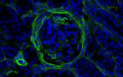 Autoimmunerkrankungen: Auslöser für Nierenschäden bei Lupus ausgemacht