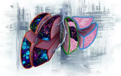 Prädiktive Biomarker für die Metastasierung bei Patienten mit Bauchspeicheldrüsenkrebs im Frühstadium