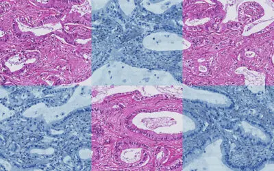 Schlauer als ChatGPT: MEVIS Forschende entwickeln Basismodell für Biomarker-Erkennung