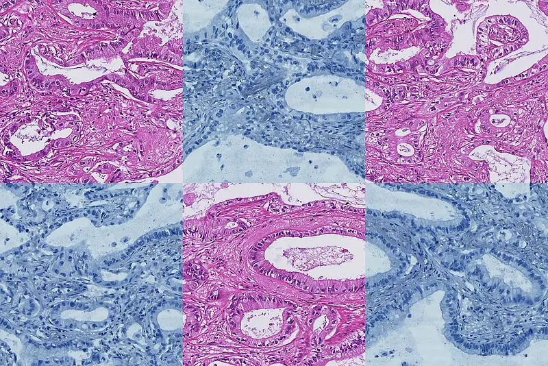 Das Bildregistrierungsverfahren Histokat-Fusion überträgt Annotationen aus zwei histologischen Färbungen aufeinander. | Copyright: © Fraunhofer MEVIS