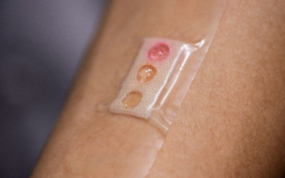 Blutzuckermessung bei Diabetes: Pflaster statt Piks