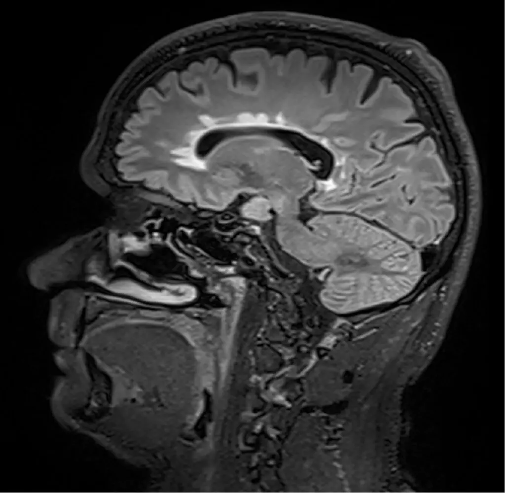 Die Aufnahmen aus der Magnetresonanztomographie zeigen mehrere entzündlichen Läsionen im Gehirn eines jungen Patienten mit Multipler Sklerose. | Quelle: Radiologie Innsbruck | Copyright: MUI/Radiologie Innsbruck 