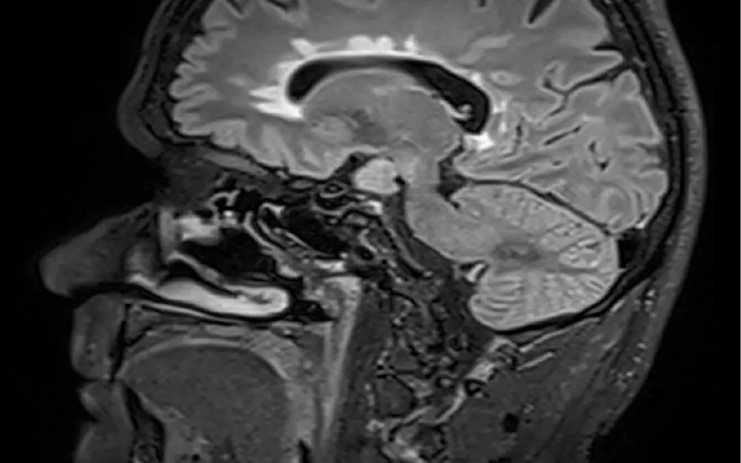 Multiple Sklerose: Häufige Läsionen im Gehirn erfordern Therapieanpassung