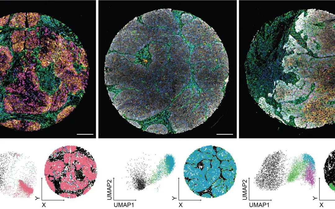Analyseverfahren revolutioniert die Diagnostik von Kopf- und Halstumoren