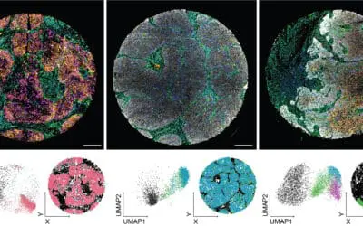 Analyseverfahren revolutioniert die Diagnostik von Kopf- und Halstumoren