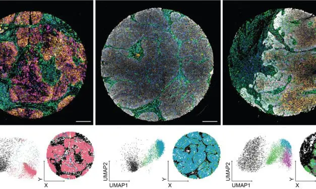 Analyseverfahren revolutioniert die Diagnostik von Kopf- und Halstumoren