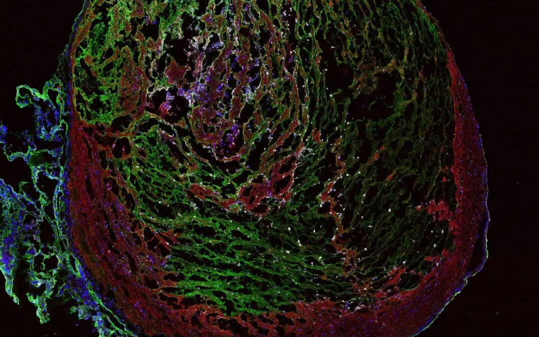 Bislang unerforschter Mechanismus um venöse Thrombose verstanden
