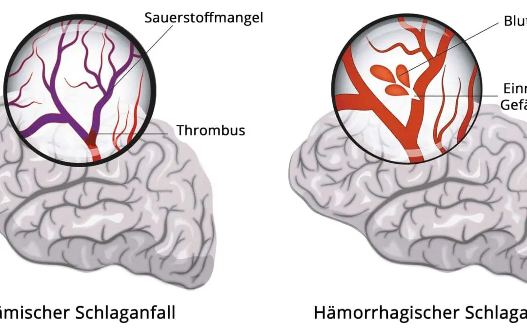 Konzeptnachweis gelungen: Biomarker sagt schwere Schlaganfallverläufe voraus