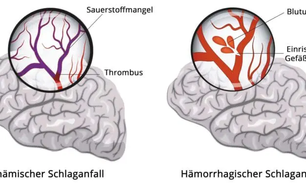 Konzeptnachweis gelungen: Biomarker sagt schwere Schlaganfallverläufe voraus