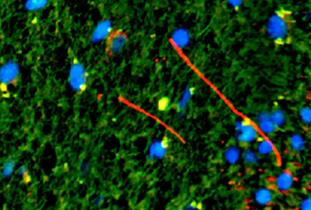 Multiple Sklerose: Weitere molekulare Mechanismen entdeckt
