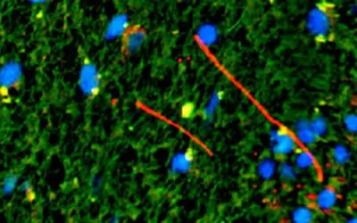 Multiple Sklerose: Weitere molekulare Mechanismen entdeckt