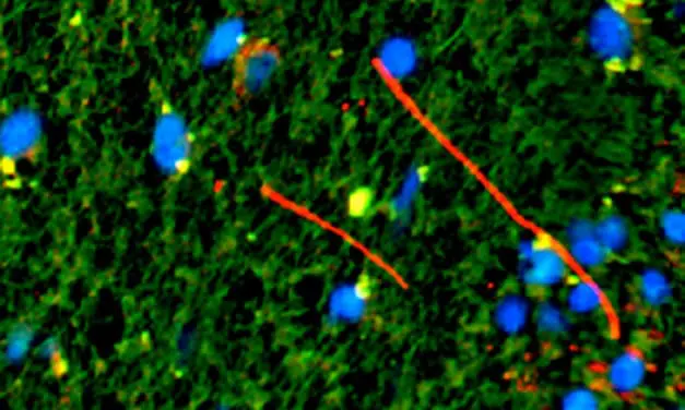 Multiple Sklerose: Weitere molekulare Mechanismen entdeckt