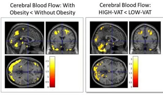RSNA 2024: Verstecktes Fett sagt Alzheimer 20 Jahre vor den Symptomen voraus