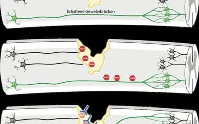 Antikörper-Therapie kann Nervenregeneration bei Querschnittslähmung verbessern