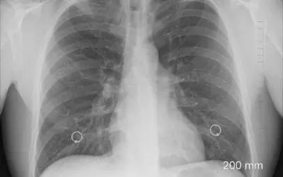 Lungenkrebs NSCLC: Osimertinib verhindert Voranschreiten um rund das Siebenfache
