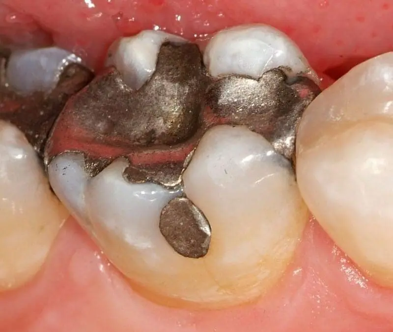 Fachgesellschaften informieren über Amalgam-Verbot 2025