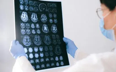Hirnstimulation verbesserte beeinträchtigte motorische Fähigkeiten nach Schlaganfall nicht