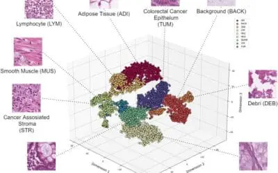 KI-Tool übertrifft bisherige Methoden der Darmkrebs-Gewebeanalyse