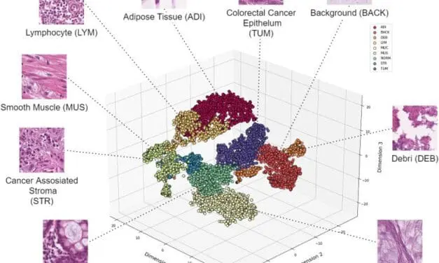 KI-Tool übertrifft bisherige Methoden der Darmkrebs-Gewebeanalyse