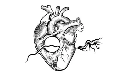 KI verbessert Risikoeinschätzung bei häufigster Herzinfarktform