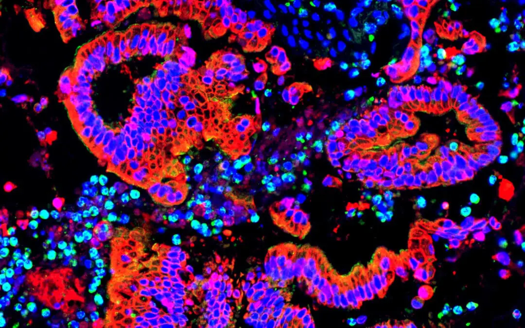 Bauchspeicheldrüsenkrebs und Immunsystem: Göttinger Wissenschaftler entdecken weitere Mechanismen