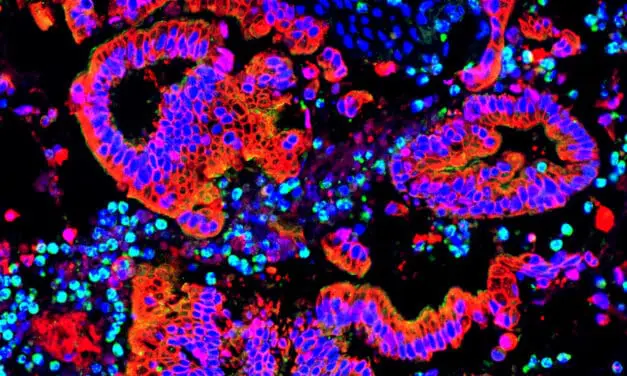 Bauchspeicheldrüsenkrebs und Immunsystem: Göttinger Wissenschaftler entdecken weitere Mechanismen