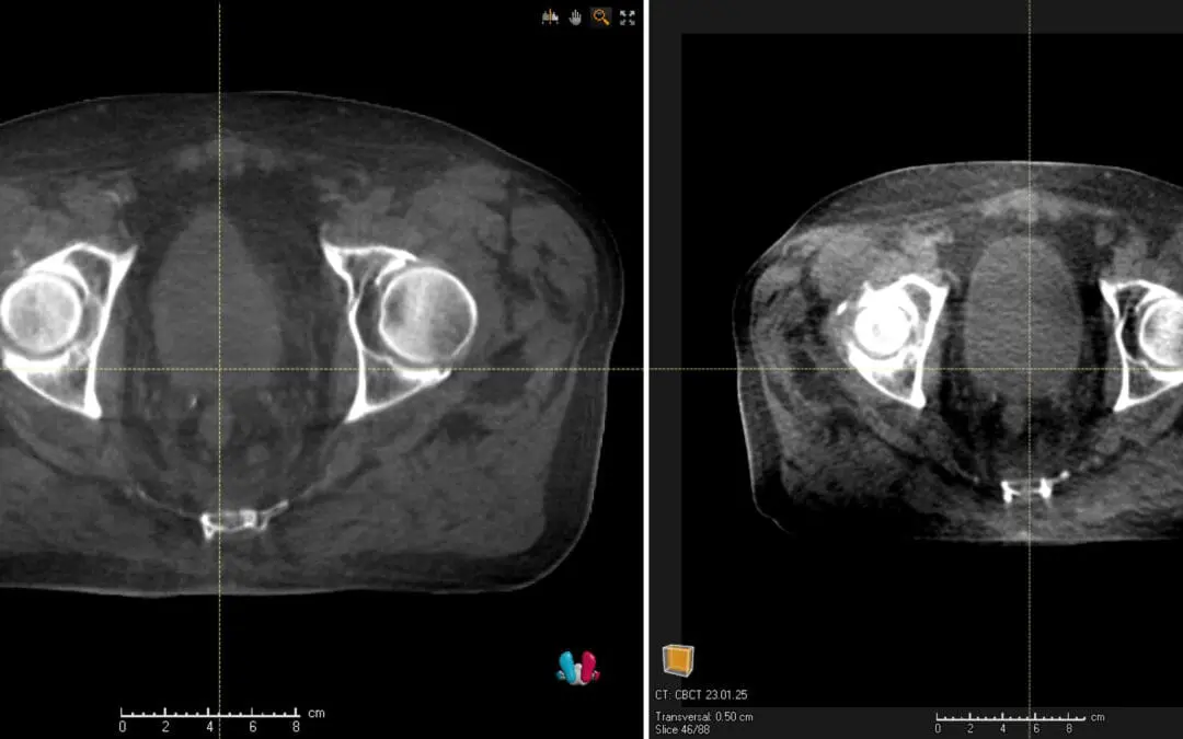 Uniklinikum Carl Gustav Carus Dresden setzt weltweit erstmals KI-gestützte Bildgebung mit Versa HD ein