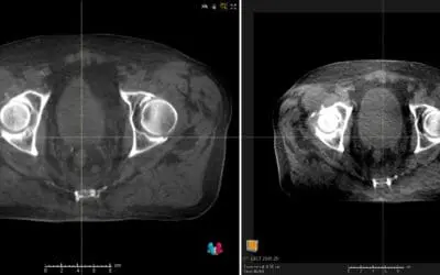 Uniklinikum Carl Gustav Carus Dresden setzt weltweit erstmals KI-gestützte Bildgebung mit Versa HD ein