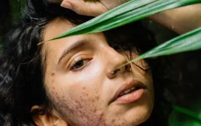 Hauterkrankung Acne inversa: Zusätzliche Bestrahlung mit Lichtimpuls und Radiofrequenz mindern Hautschäden