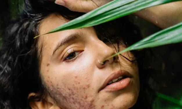 Hauterkrankung Acne inversa: Zusätzliche Bestrahlung mit Lichtimpuls und Radiofrequenz mindern Hautschäden