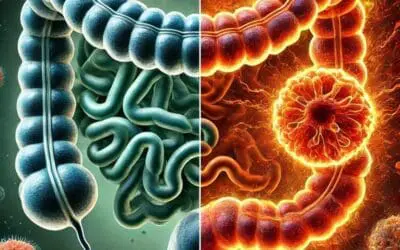 Darmkrebs: Protein HKDC1 beeinflusst Tumorwachstum