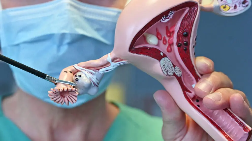 Demonstration der Eileiterentfernung, eine bei geplanten Unterleibs-OPs bei Frauen mit abgeschlossener Familienplanung bereits häufige Prävention gegen Eierstockkrebs. (Credits: Michael Szabó, Modell: GPI Anatomicals, USA/Universitätsklinikum Jena)
