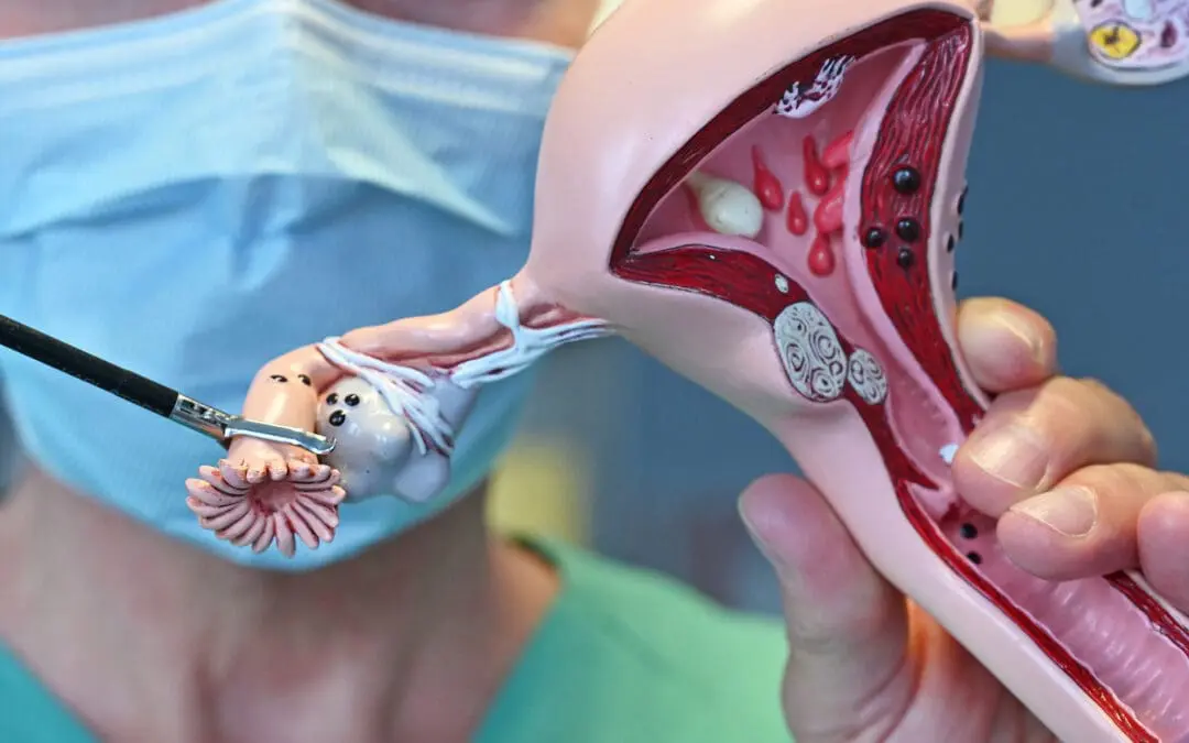 Prophylaktische Entfernung der Eileiter kann Krebsfälle und Gesundheitskosten deutlich reduzieren