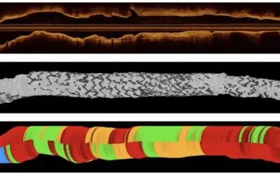 DeepNeo automatisiert Analyse von koronaren Stents nach der Implantation