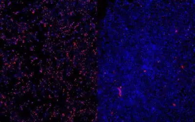 Neuer Therapieansatz für seltene Epilepsie am LMU Klinikum erfolgreich