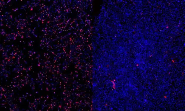 Neuer Therapieansatz für seltene Epilepsie am LMU Klinikum erfolgreich